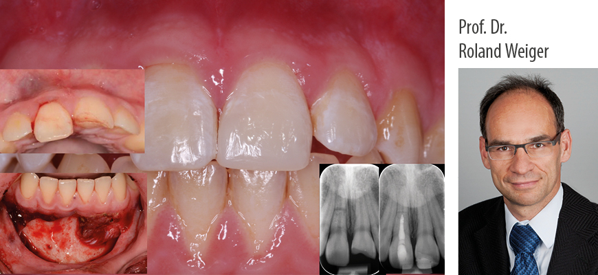 Prof. Dr. Roland Weiger: Das Zahntrauma - Was sollte der Zahnarzt wissen und tun? - Kurs: 9813