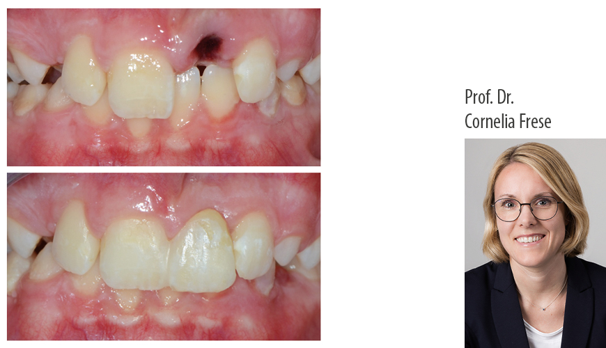 Prof. Dr. Cornelia Frese: Faserverstärkte Komposite in der Zahnheilkunde – Einzelzahnersatz und postendodontische Versorgung tief zerstörter Zähne - Kurs: 9823