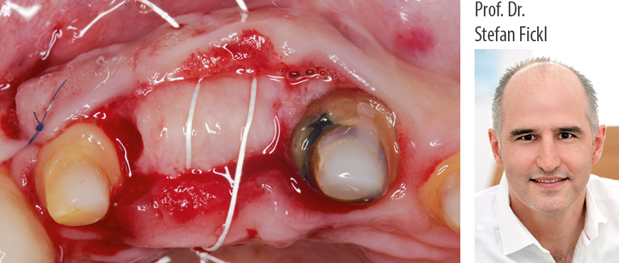 Prof. Dr. Stefan Fickl: Weichgewebsmanagement in der Parodontologie und Implantologie - Kurs: 5263