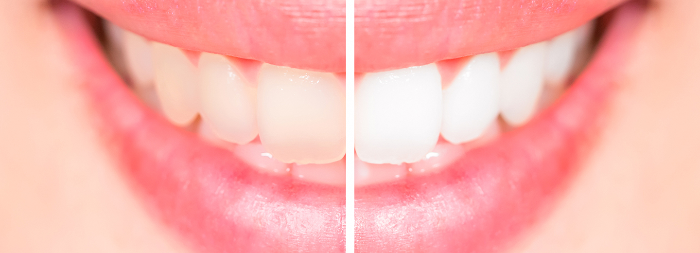 PD Dr. Pune Nina Paqué: Bleaching A-Z - Kurs: 9807